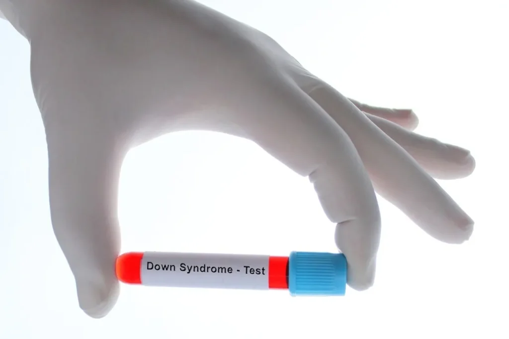 Down Sendromu Riski